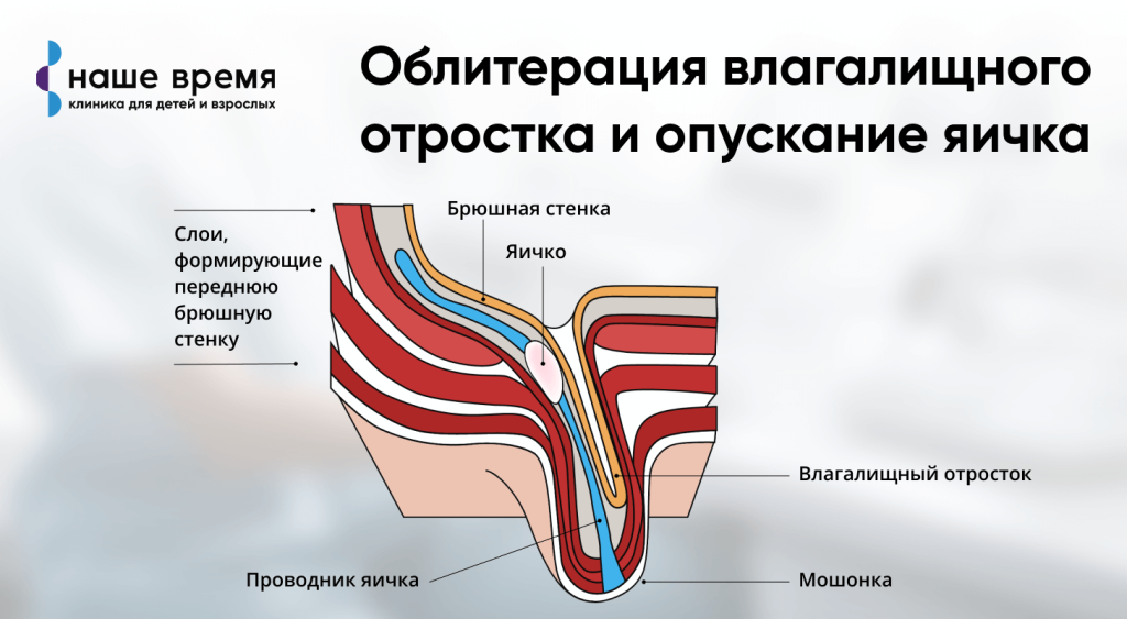 Паховые грыжи у детей