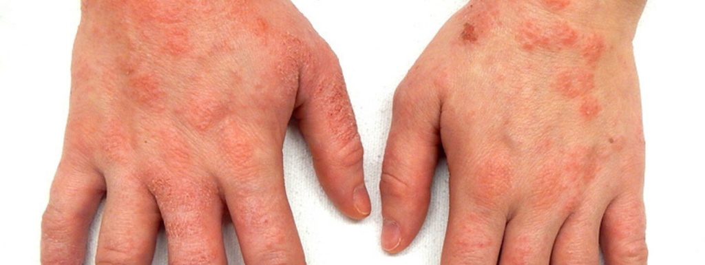 Почему облазит кожа: причины и методы лечения заболевания