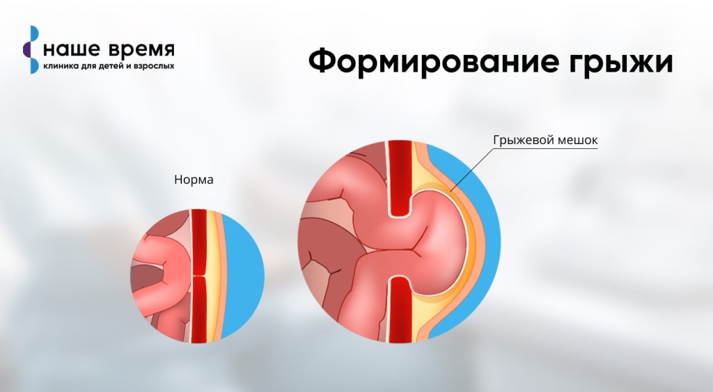 Паховая грыжа у ребенка