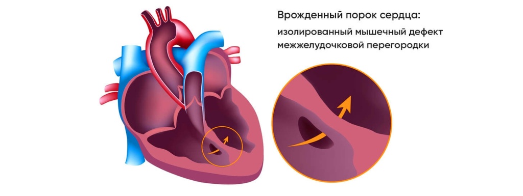 Расширение сердца. Сердечно-сосудистые заболевания ВПС. Сердечной недостаточности кардиомиопатии. Аневризма сердца что это такое симптомы.