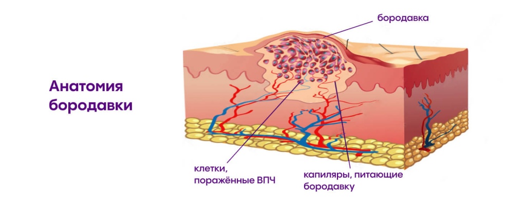 Аногенитальные (венерические) бородавки